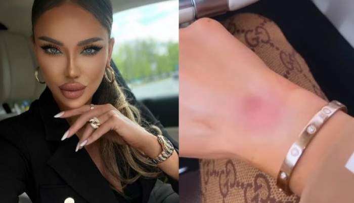 Bianca Drăgușanu, cu lovituri pe mâini! Ce a pățit vedeta după scandalul cu Gabi Bădălău / FOTO