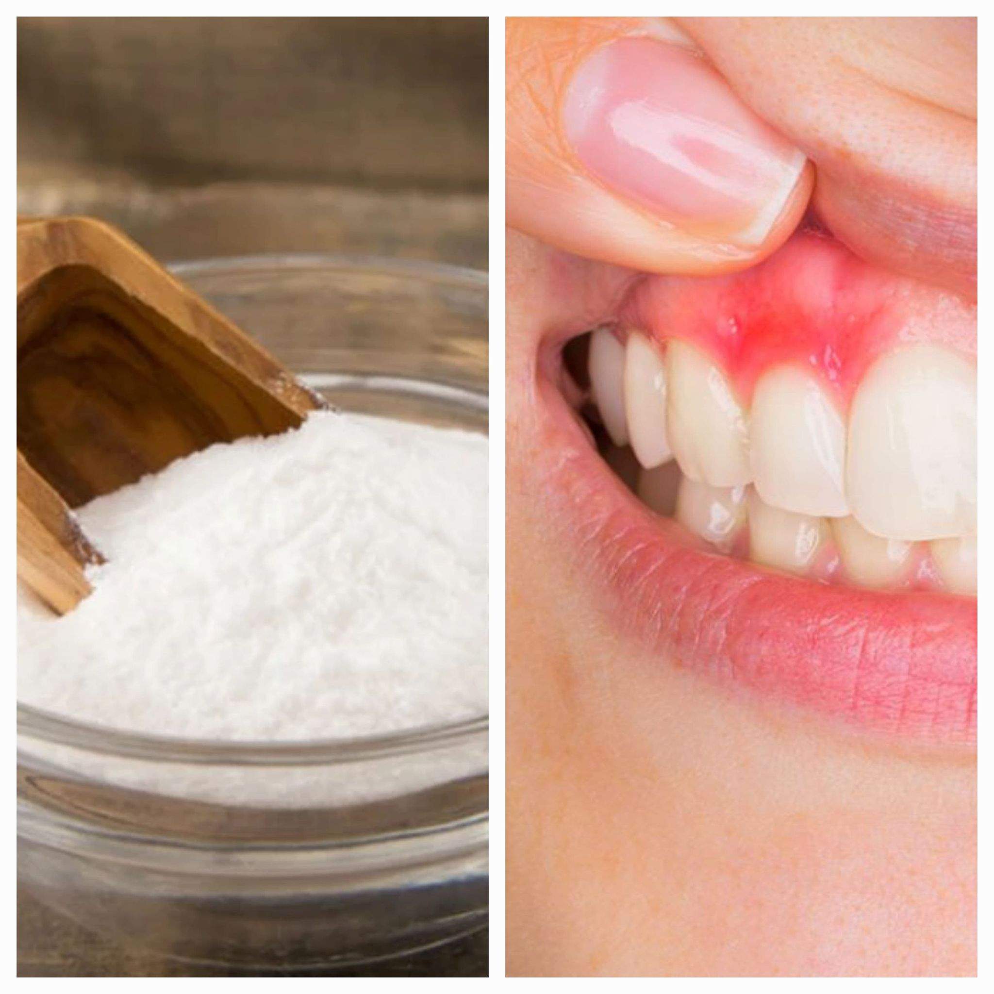 Bicarbonat de sodiu pentru gingiile inflamate
