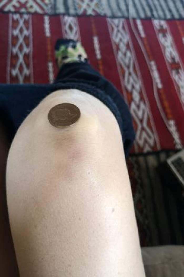 O femeie susține că a fost răpită de extratereștri, în mod repetat, și spune că are dovezi: „Mi-au lăsat urme ciudate pe corp...”