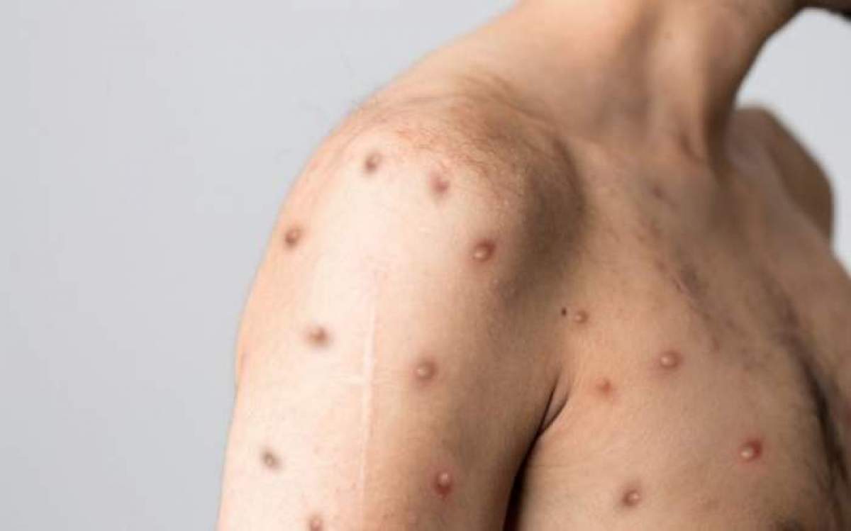 A fost confirmat al șaselea caz de variola maimuței în România. Este vorba tot despre un bărbat