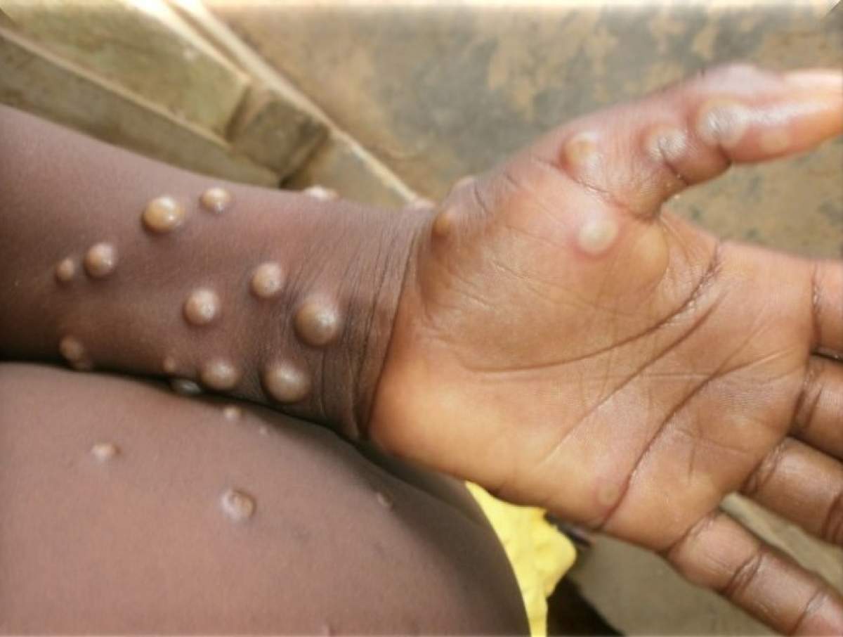 Au fost confirmate alte trei cazuri de variola maimuței în România. Câte persoane sunt infectate în prezent