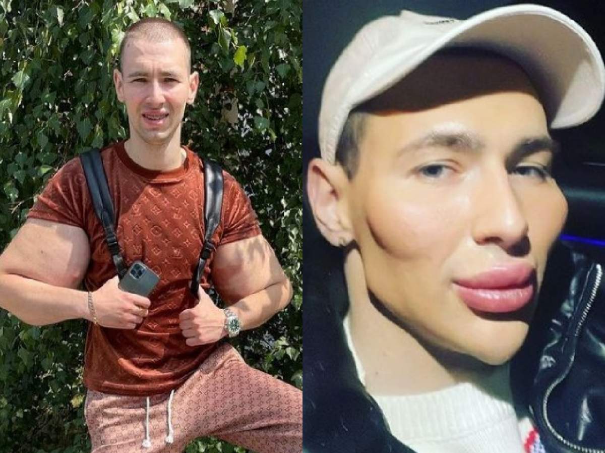 Popeye, rusul cu ulei în brațe, înainte și după operații