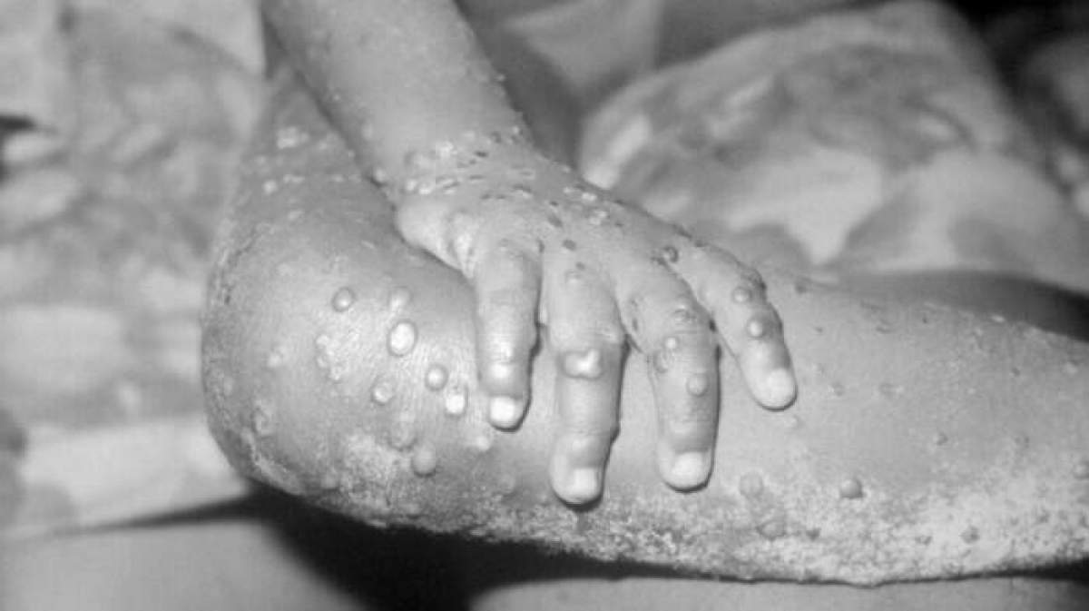Alte două cazuri de variola maimuței în România. Este vorba despre un bărbat din Ilfov și un altul, din Cluj