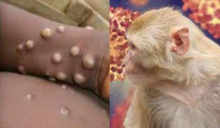 Au fost confirmate alte două cazuri noi de variola maimuței. Ambele persoane infectate sunt din București