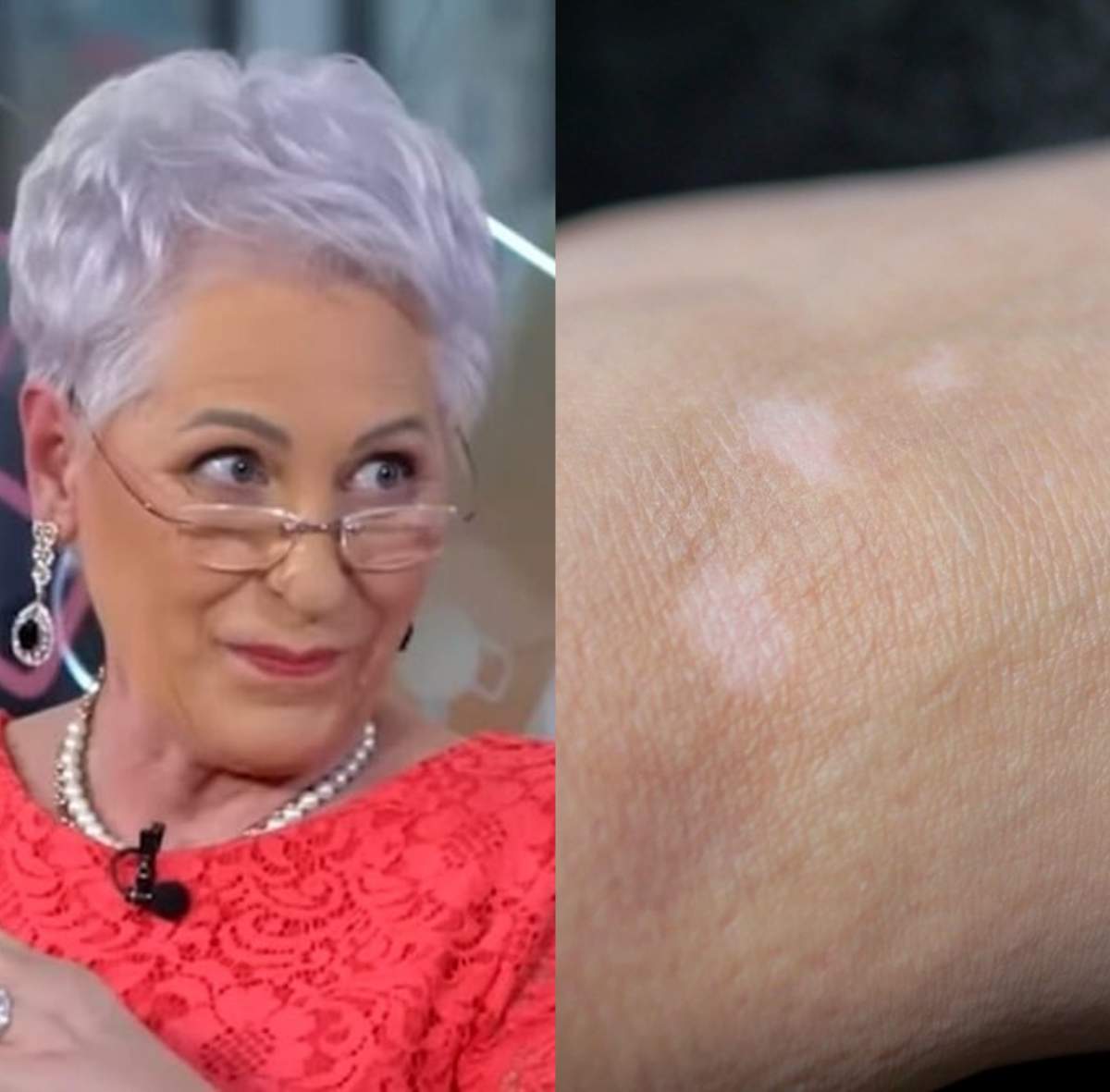 colaj din doua poze lidia fecioru si vitiligo