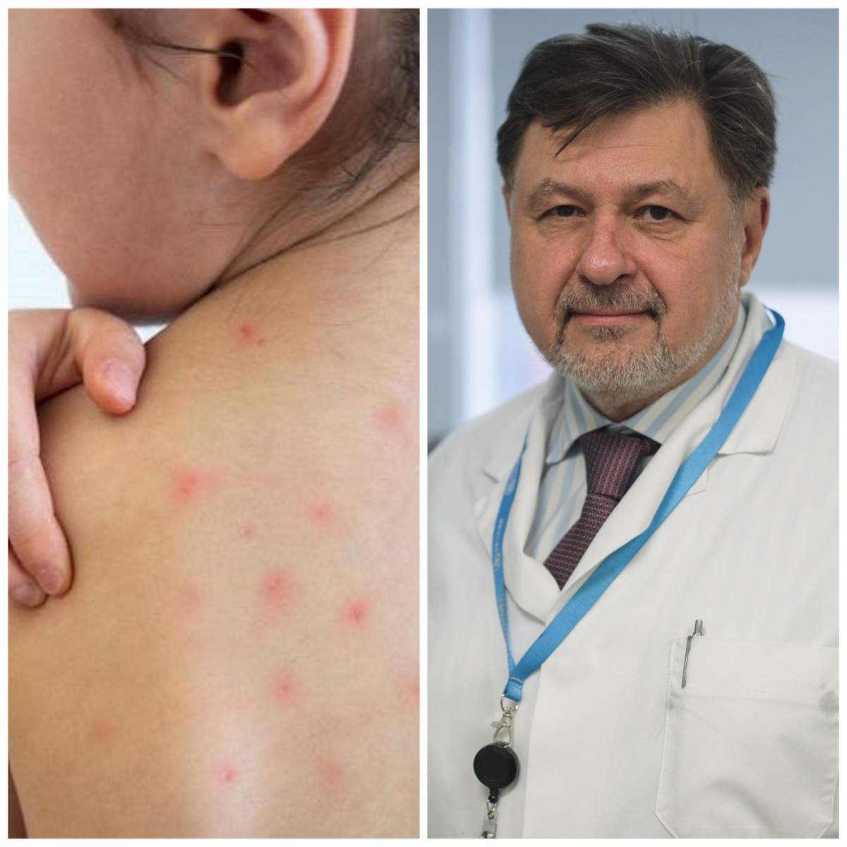 Epidemie de rujeolă în România