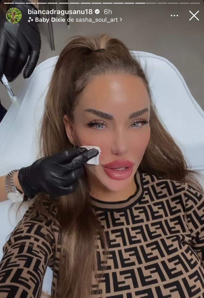 Bianca Drăgușanu, din nou pe mâna medicului estetician! Ce schimbare și-a făcut vedeta: "Am o problemă…” / FOTO