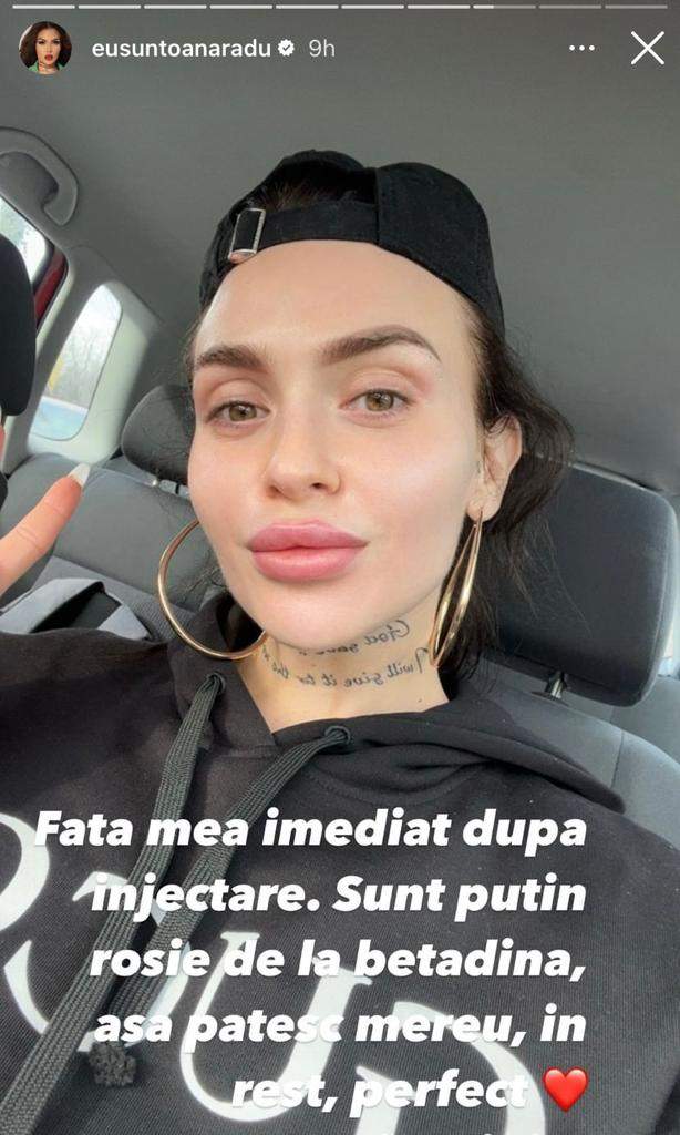 Oana Radu a apelat la o nouă intervenție estetică. Cum arată artista după procedură: "Fața mea după injectare“ / FOTO