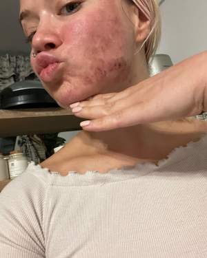Simona Mereu, noi detalii despre problemele cauzate de acneea severă. Cum arată cea mai bună dansatoare din România după tratamente: „Multe ore petrecute căutând soluții...”