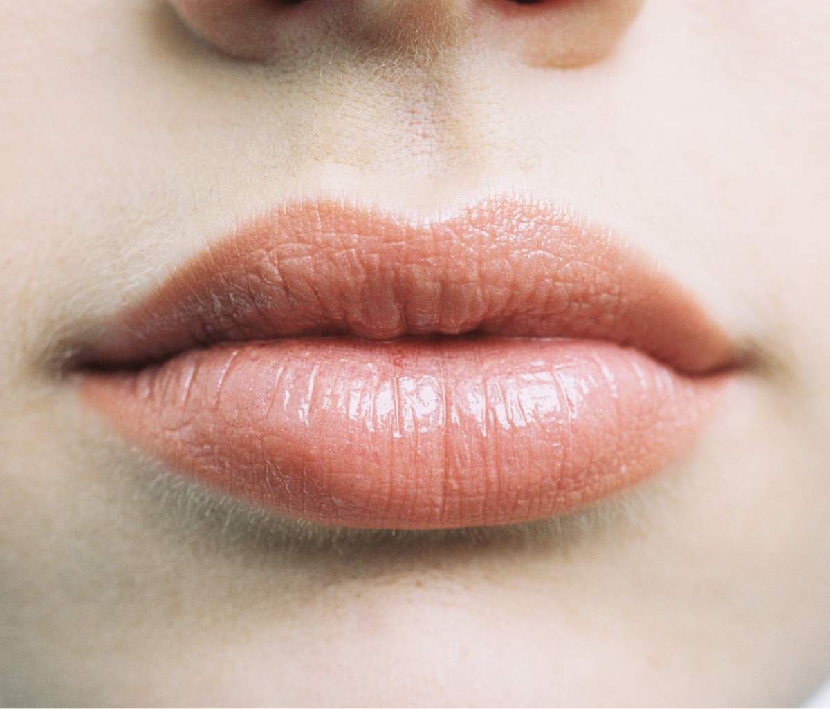 Ce efect are acidul hialuronic asupra buzelor. Explicațiile medicilor specialiști