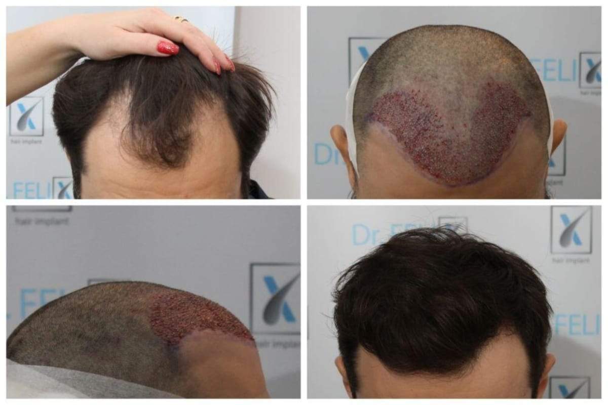 (P) Încearcă și tu un implant de păr profesional în București realizat la clinica Dr Felix Hair Implant!