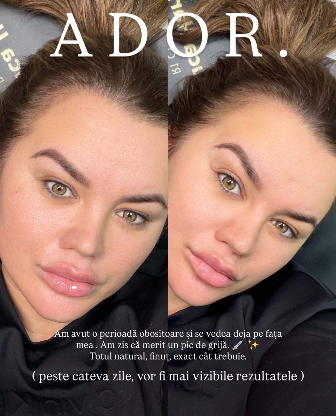 Carmen de la Sălciua, pe mâna medicului estetician! La ce intervenții a apelat cântăreața