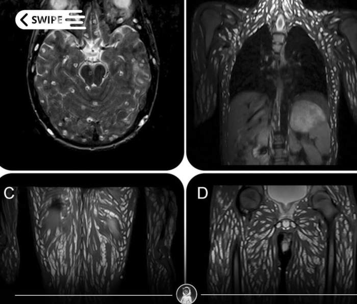Radiografia femeii care a mâncat carne crudă