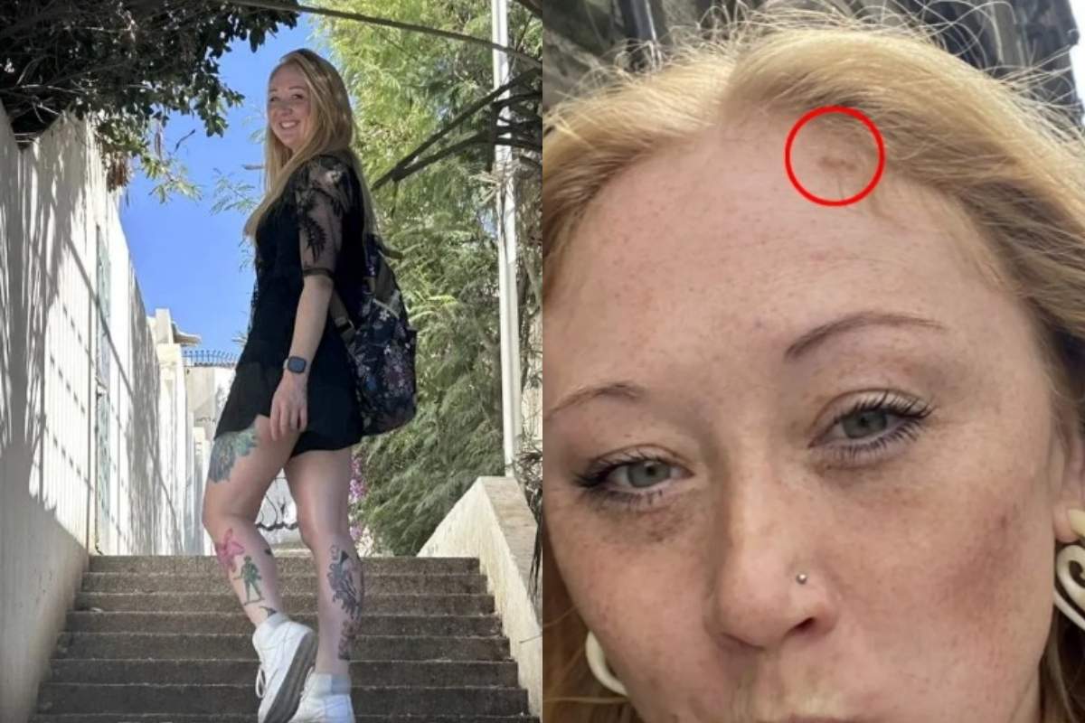 O femeie a fost diagnosticată cu cancer de piele după ce a mers la solar. A avut nevoie de 13 operații