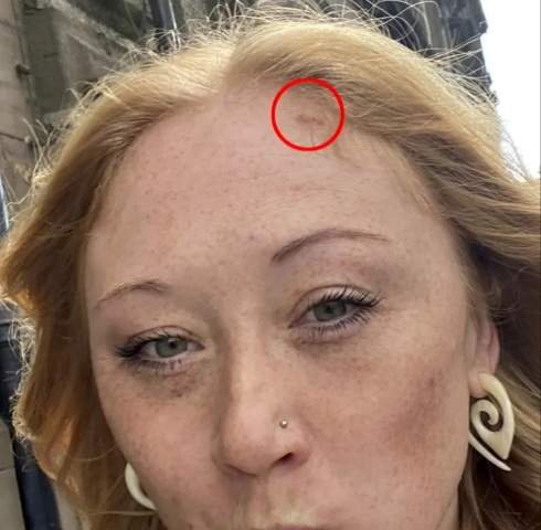 O femeie a fost diagnosticată cu cancer de piele după ce a mers la solar. A avut nevoie de 13 operații