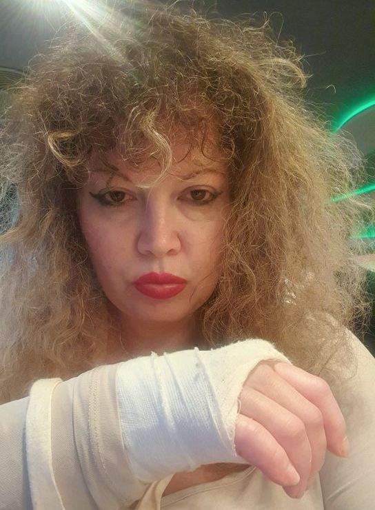 Oana Lis, cu mâna ruptă