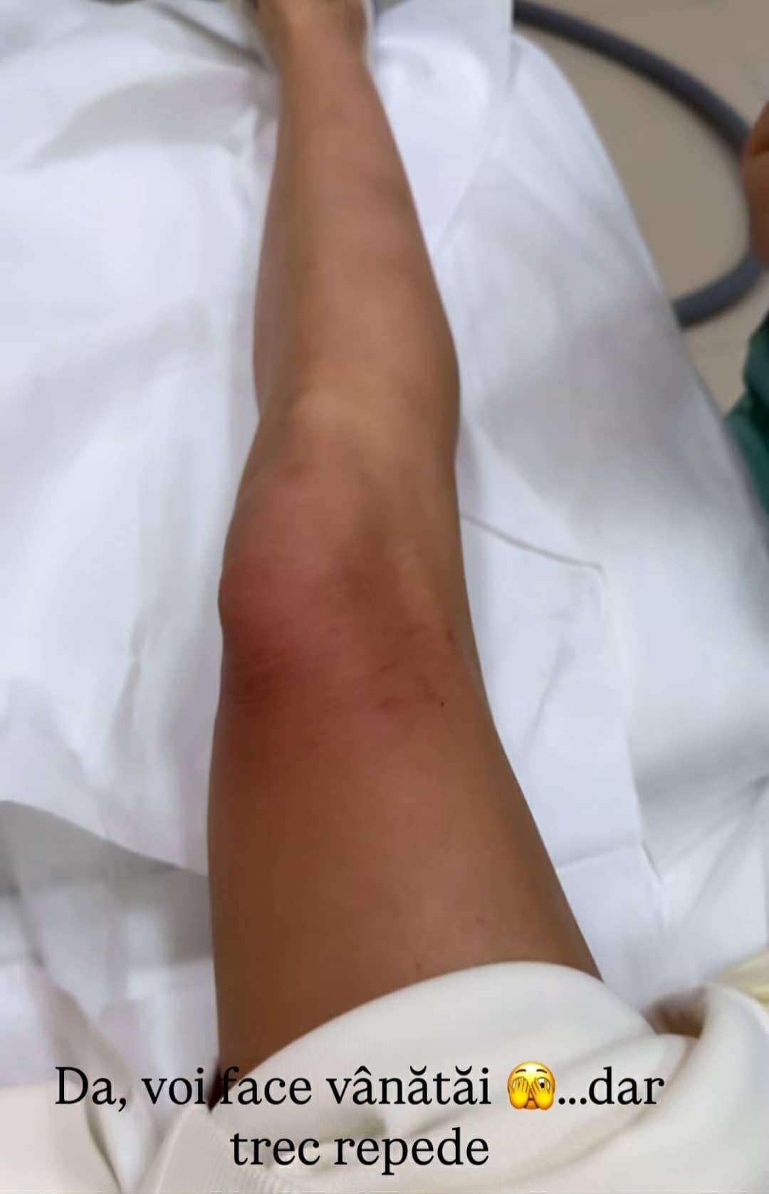 piciorul Alinei Pușcaș