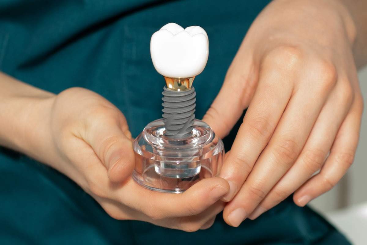 (P) Componentele unui implant dentar: Care sunt elementele?