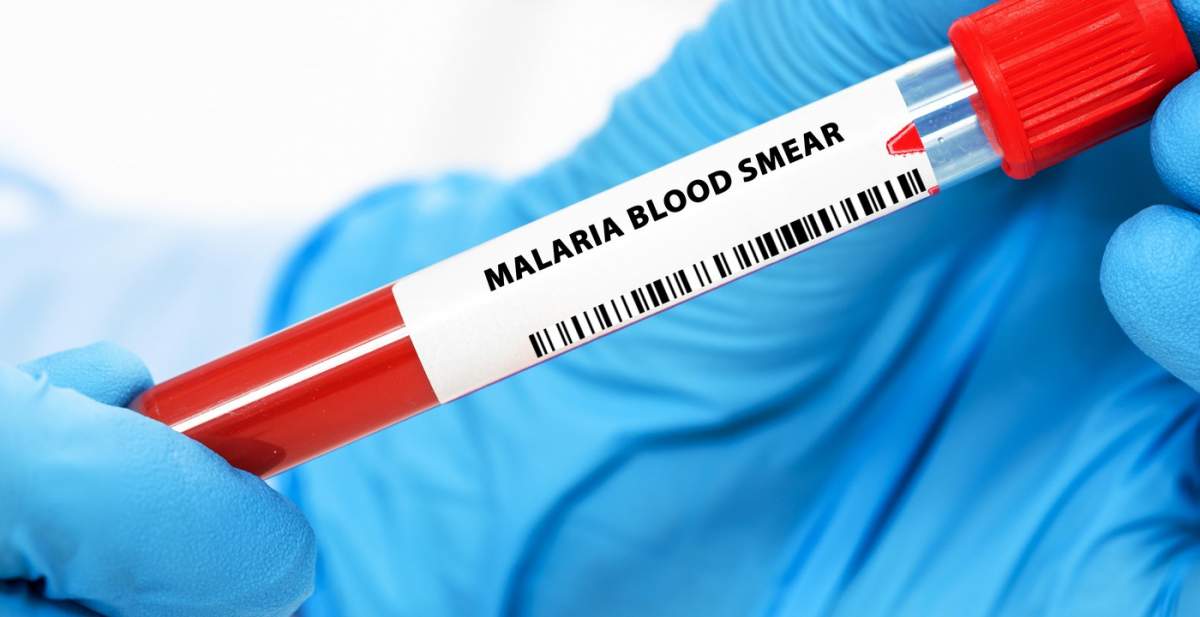 Frotiu de sânge pentru malarie. Identifică paraziții malariei din sânge pentru diagnosticarea malariei.