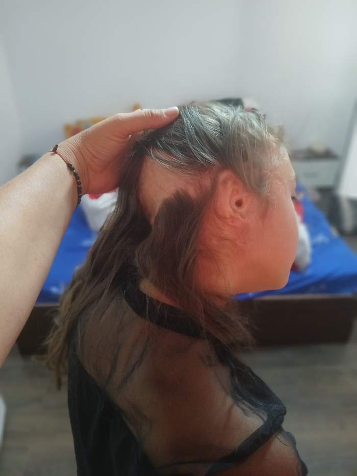 Apel umanitar: Andreea, o fetiță de 11 ani care a fost mutilată de câini, are nevoie de noi pentru a-și reface urechea!