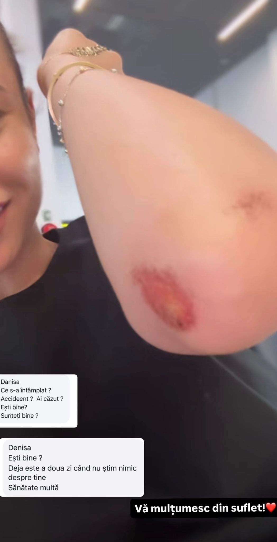 Denisa Filcea, accident la Watersports! Ce mesaj a postat vedeta pe Instagram pentru fani: „Nu pot să-mi ridic mâna”