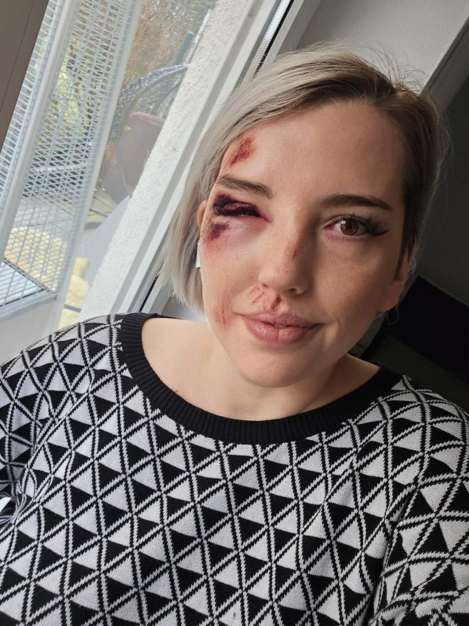 Influencerița mutilată din cauza unui accident
