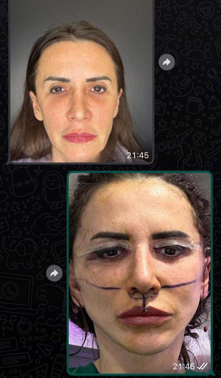 Foto cu Mara Bănică, înainte și după liftingul facial