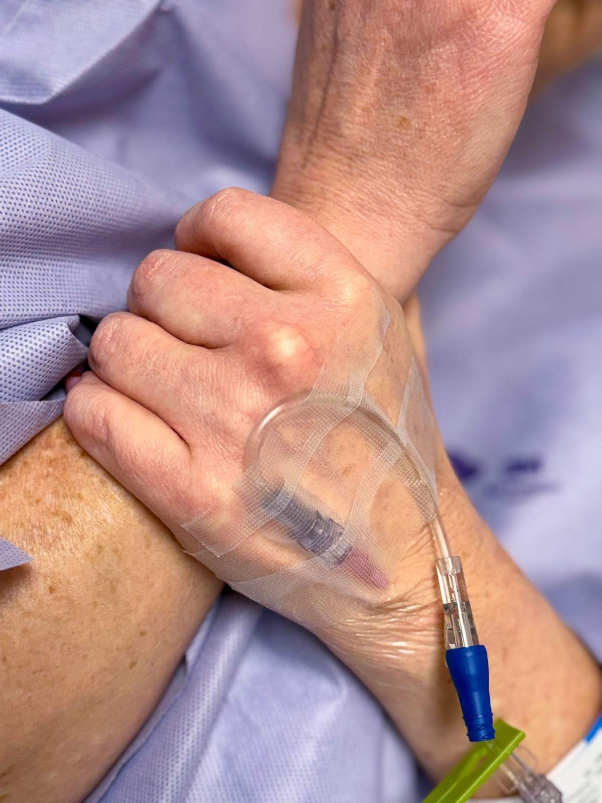 Prim-planul unui implant intravenos fixat pe mâna unui pacient, cu tubulatura și cateterul la locul lor, reflectând o anticipare liniștită înainte de operație într-un set medical calm