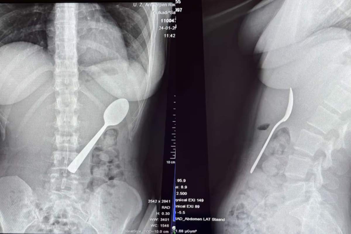 O femeie a înghițit o lingură de 17 cm în timp ce mânca iaurt. Cum a fost posibil