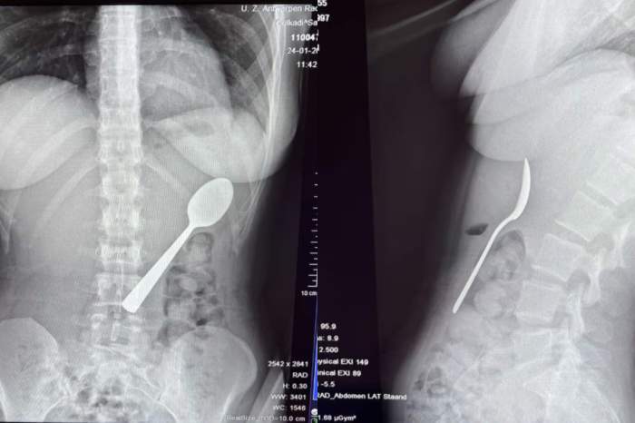 O femeie a înghițit o lingură de 17 cm în timp ce mânca iaurt. Cum a fost posibil