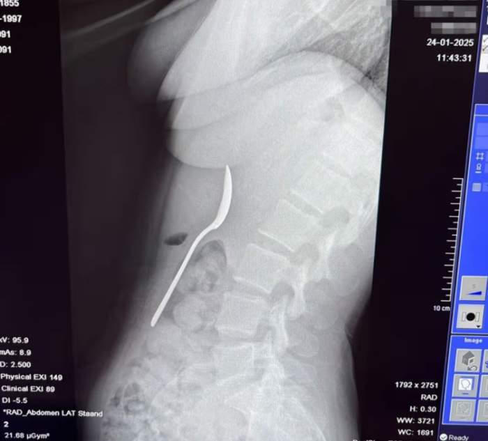 O femeie a înghițit o lingură de 17 cm în timp ce mânca iaurt. Cum a fost posibil