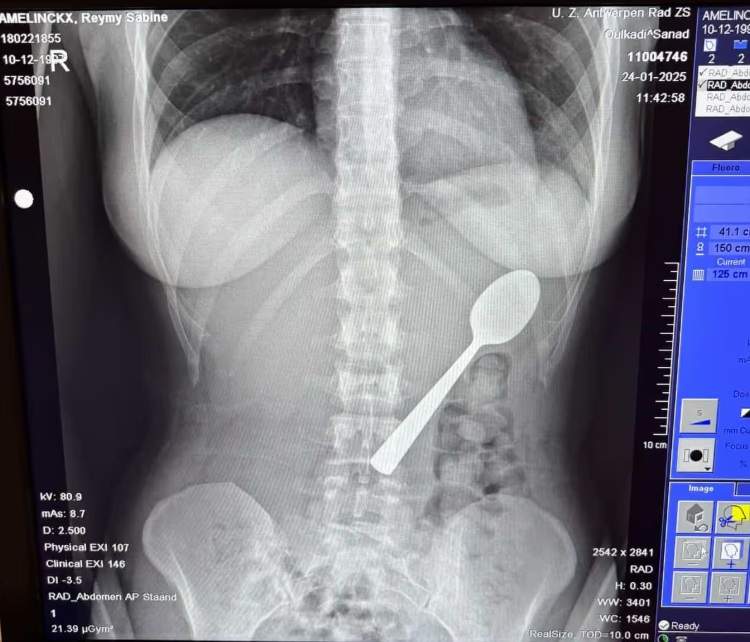 O femeie a înghițit o lingură de 17 cm în timp ce mânca iaurt. Cum a fost posibil