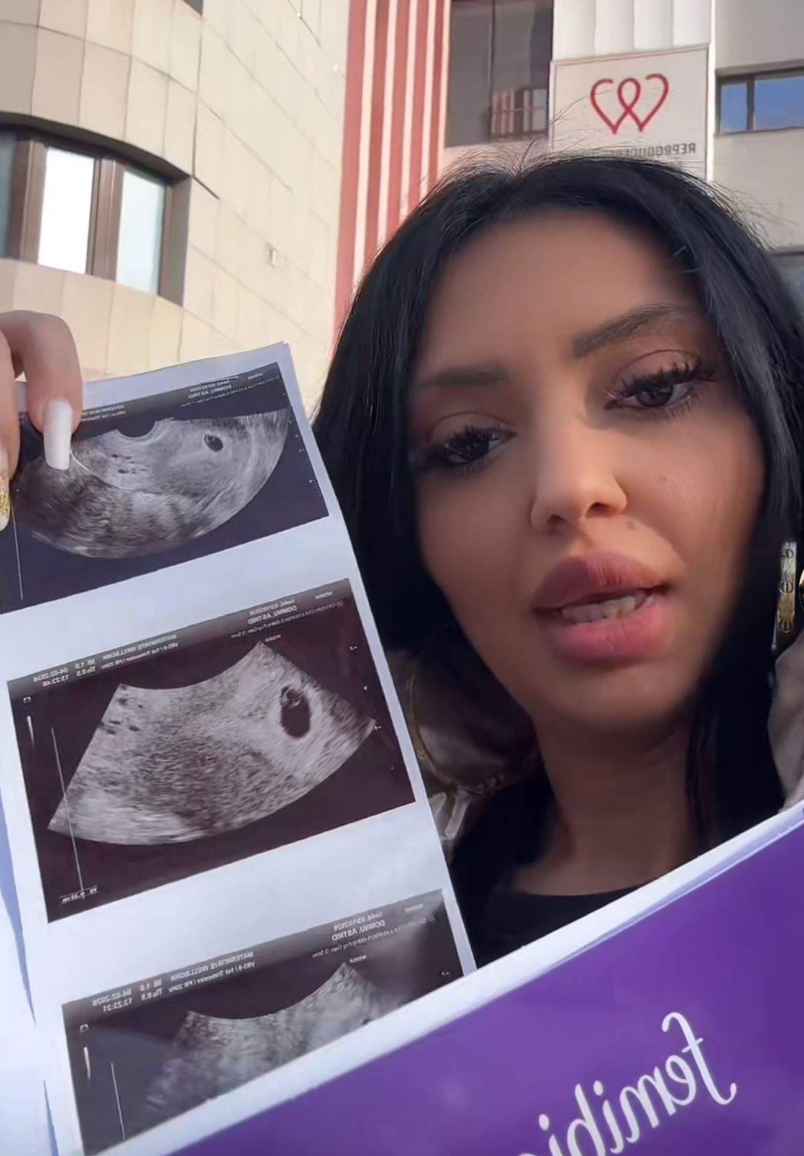 Sora lui Albert NBN a arătat ecografia