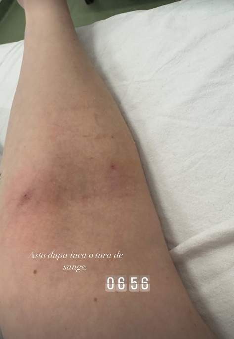 ioana chisiu cu mana vanata la spital