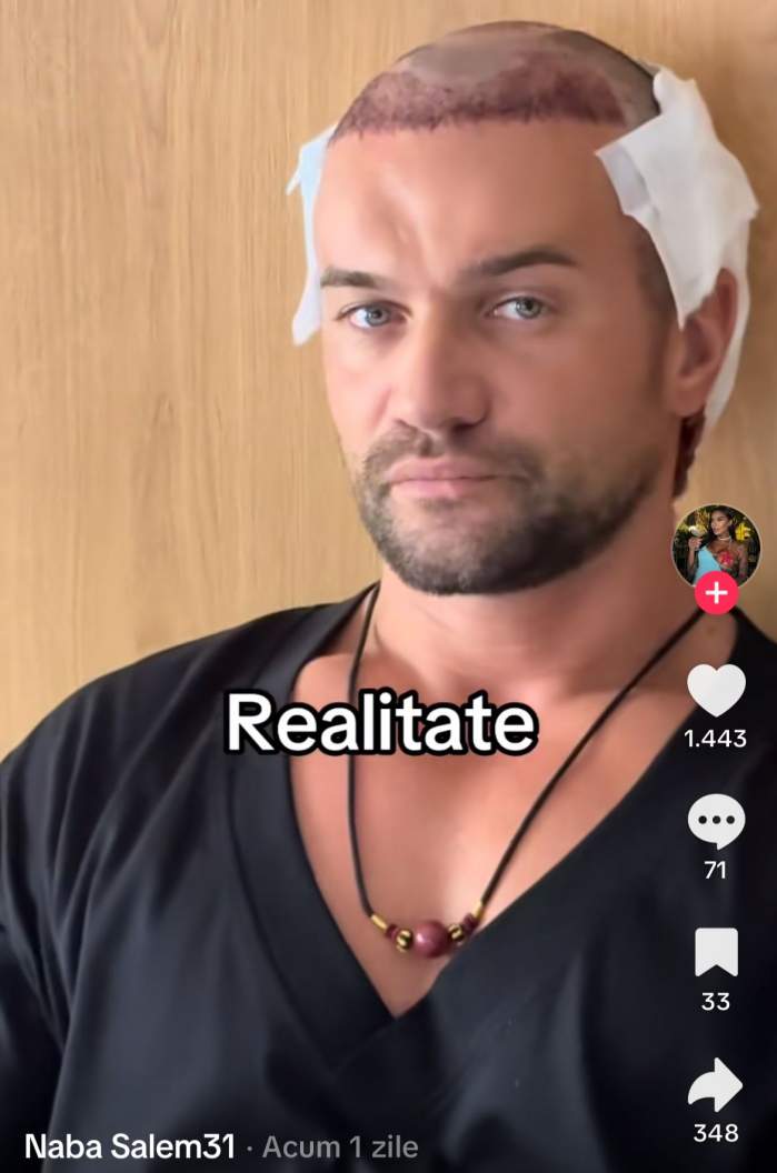 Cătălin Brînză, după implantul de păr