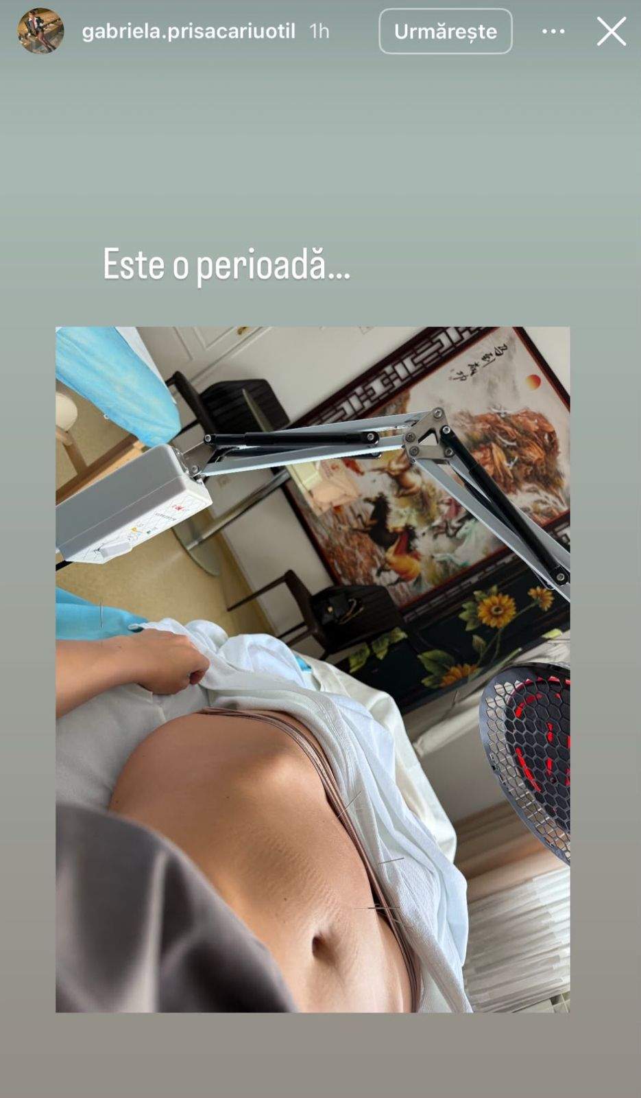 Gabriela Prisăcariu face acupunctură