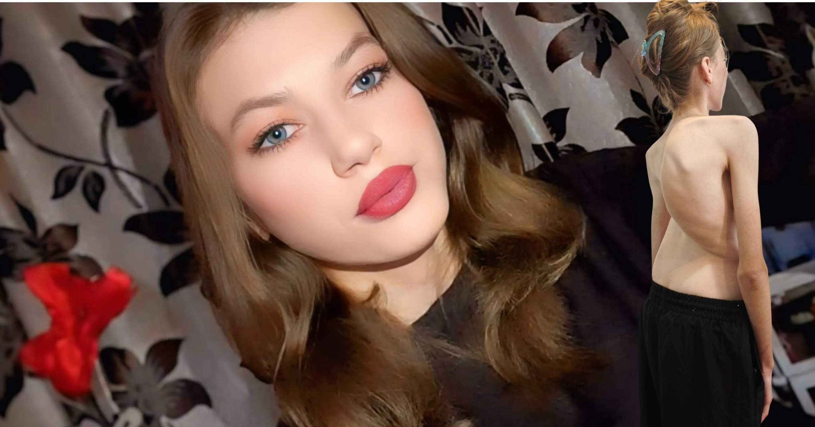 Apel umanitar: La 16 ani, Denisa are nevoie de ajutor pentru operația care îi poate reda șansa la o viață normală