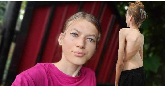 Apel umanitar: La 16 ani, Denisa are nevoie de ajutor pentru operația care îi poate reda șansa la o viață normală
