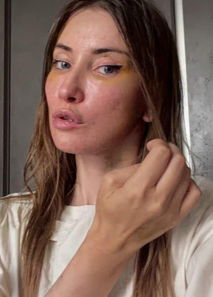 Iulia Albu a dezvăluit de ce a ajuns pe patul de spital. Vedeta s-a afișat cu fața învinețită | FOTO