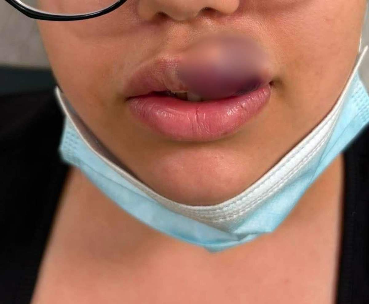 Tânăra care a ajuns la spital după ce și-a injectat buzele