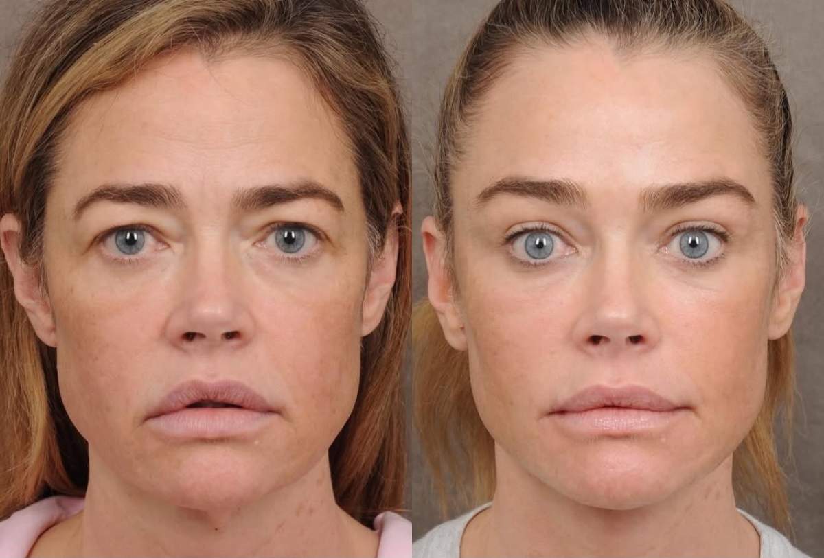 Denise Richards, înainte și după liftingul facial