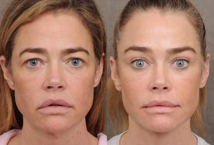 Denise Richards, înainte și după liftingul facial